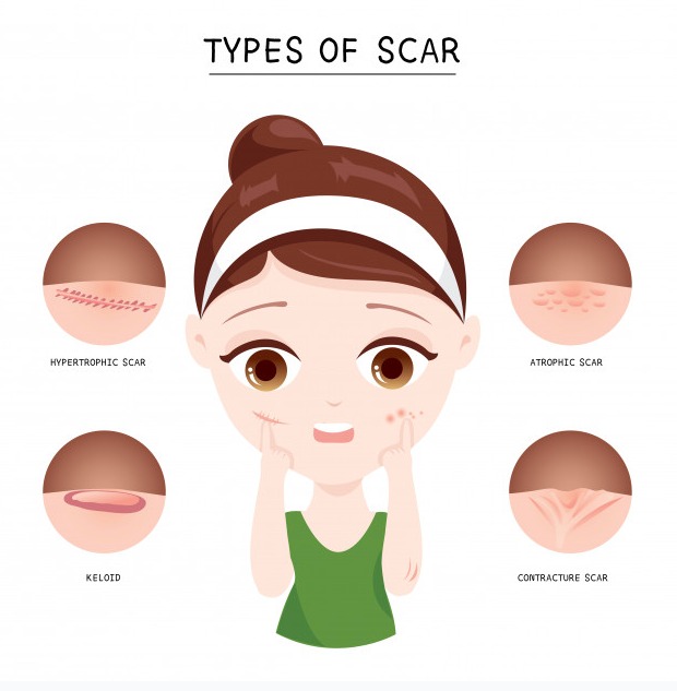 Cicatrización de la piel